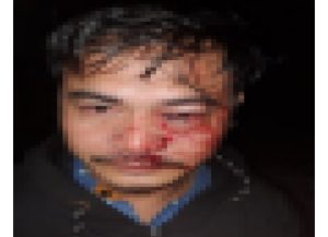 Ironis! YG Korban Pemukulan Melapor Duluan, Kenapa Pelaku yang Didahulukan? Ada Apa dengan Polsek Tanjungpinang Timur?